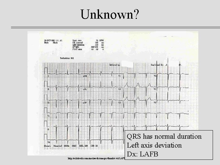 Unknown? QRS has normal duration Left axis deviation Dx: LAFB http: //askdrwiki. com/mediawiki/images/thumb/c/cd/LAFB. jpg/750