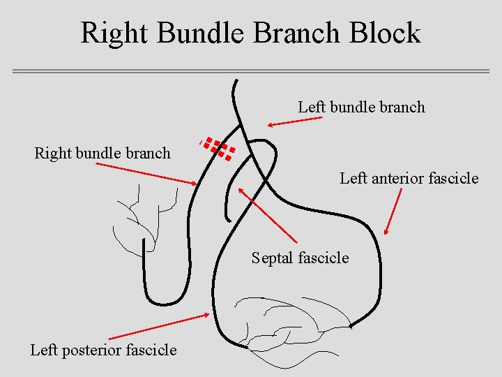 Right Bundle Branch Block Left bundle branch Right bundle branch Left anterior fascicle Septal
