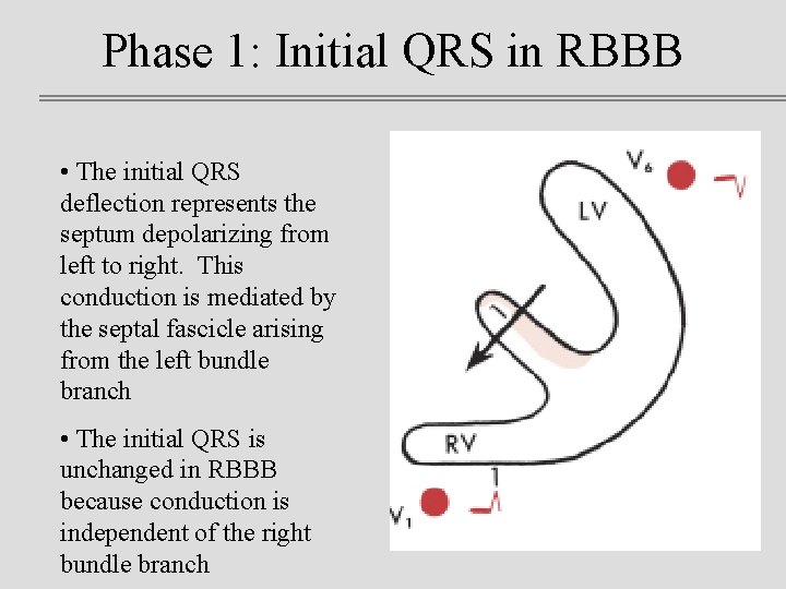 Phase 1: Initial QRS in RBBB • The initial QRS deflection represents the septum