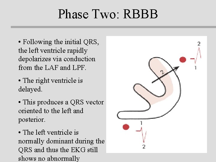 Phase Two: RBBB • Following the initial QRS, the left ventricle rapidly depolarizes via