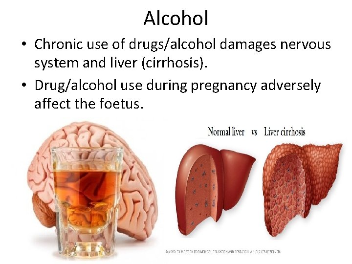 Alcohol • Chronic use of drugs/alcohol damages nervous system and liver (cirrhosis). • Drug/alcohol