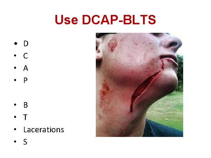 Use DCAP-BLTS • • D C A P • • B T Lacerations S
