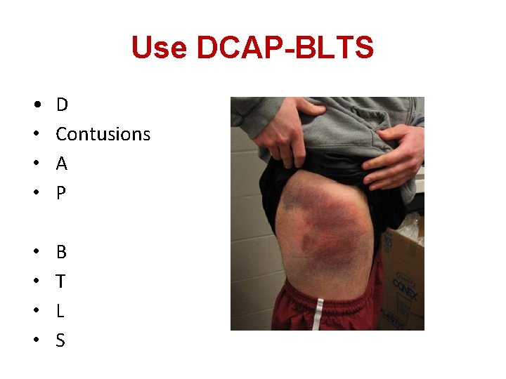 Use DCAP-BLTS • • D Contusions A P • • B T L S