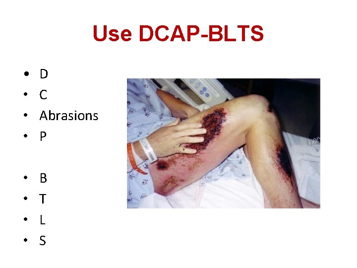 Use DCAP-BLTS • • D C Abrasions P • • B T L S