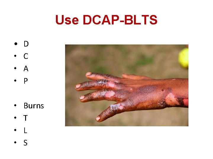 Use DCAP-BLTS • • D C A P • • Burns T L S