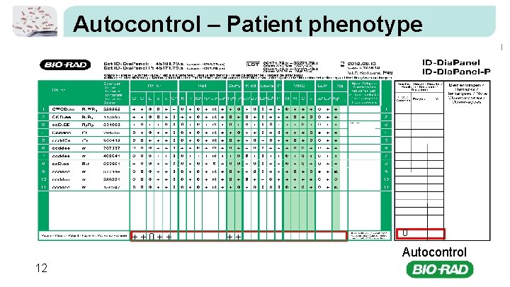 Autocontrol – Patient phenotype ++0++ ++ 0 Autocontrol 12 