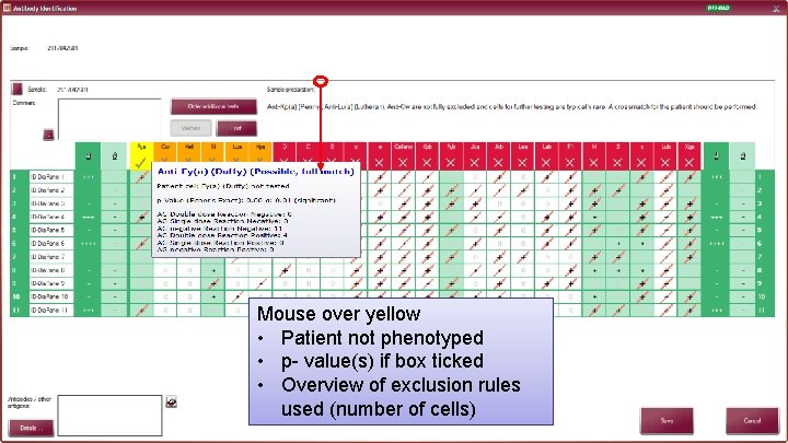 28 Mouse over yellow • Patient not phenotyped • p- value(s) if box ticked