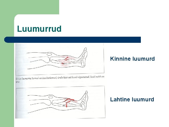 Luumurrud Kinnine luumurd Lahtine luumurd 