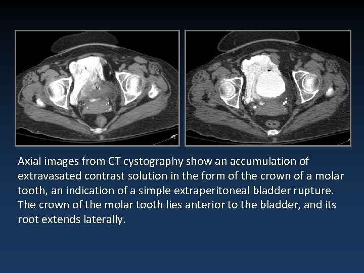 Axial images from CT cystography show an accumulation of extravasated contrast solution in the