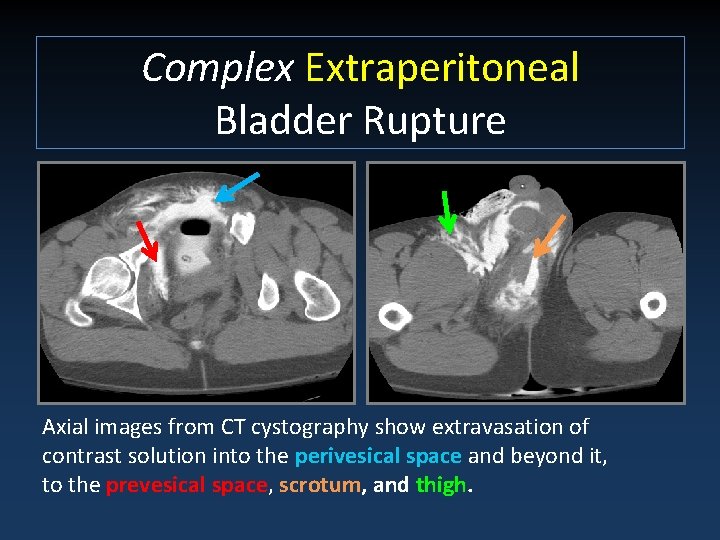 Complex Extraperitoneal Bladder Rupture Axial images from CT cystography show extravasation of contrast solution