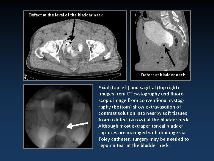 Defect at the level of the bladder neck Defect at bladder neck Axial (top