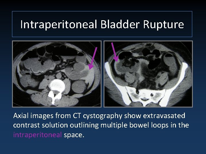 BLADDER INJURY TYPES MECHANISMS AND DIAGNOSTIC IMAGING Jordan