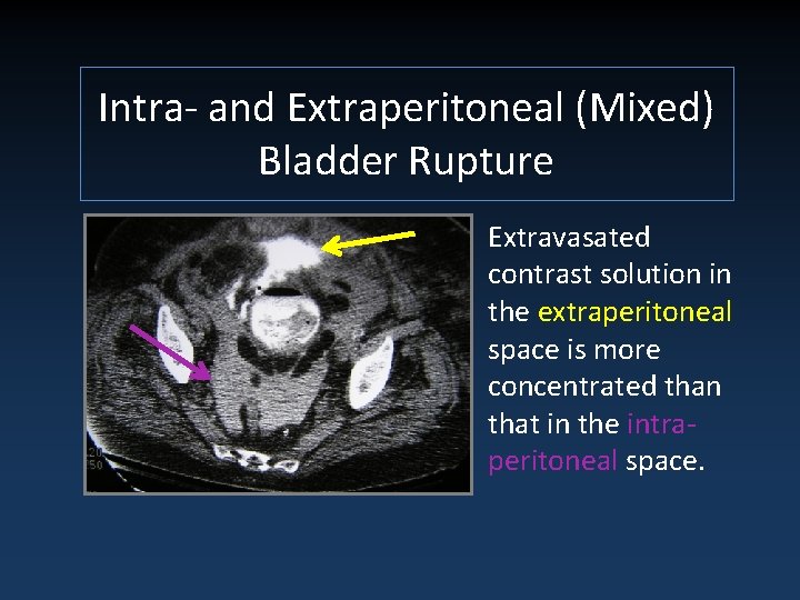 Intra- and Extraperitoneal (Mixed) Bladder Rupture Extravasated contrast solution in the extraperitoneal space is