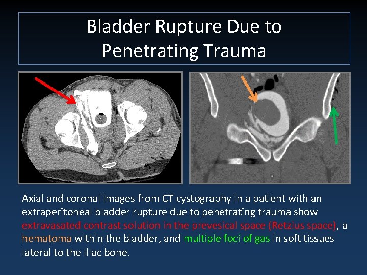 Bladder Rupture Due to Penetrating Trauma Axial and coronal images from CT cystography in