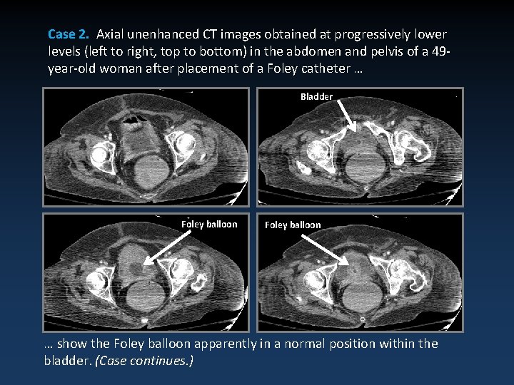 Case 2. Axial unenhanced CT images obtained at progressively lower levels (left to right,