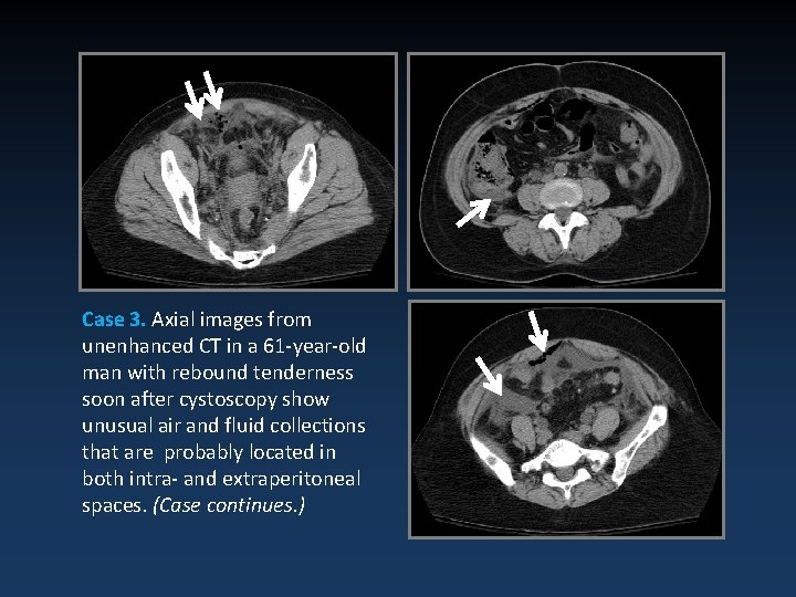Case 3. Axial images from unenhanced CT in a 61 -year-old man with rebound