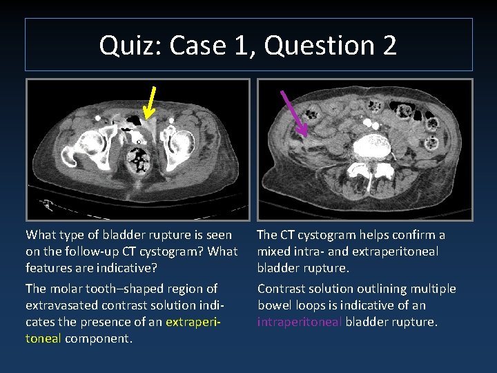 Quiz: Case 1, Question 2 What type of bladder rupture is seen on the