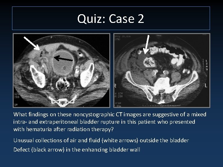 Quiz: Case 2 What findings on these noncystographic CT images are suggestive of a