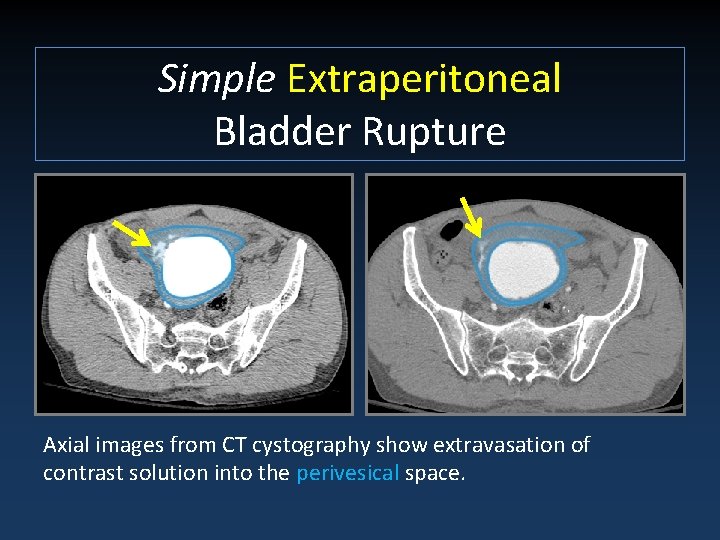 Simple Extraperitoneal Bladder Rupture Axial images from CT cystography show extravasation of contrast solution