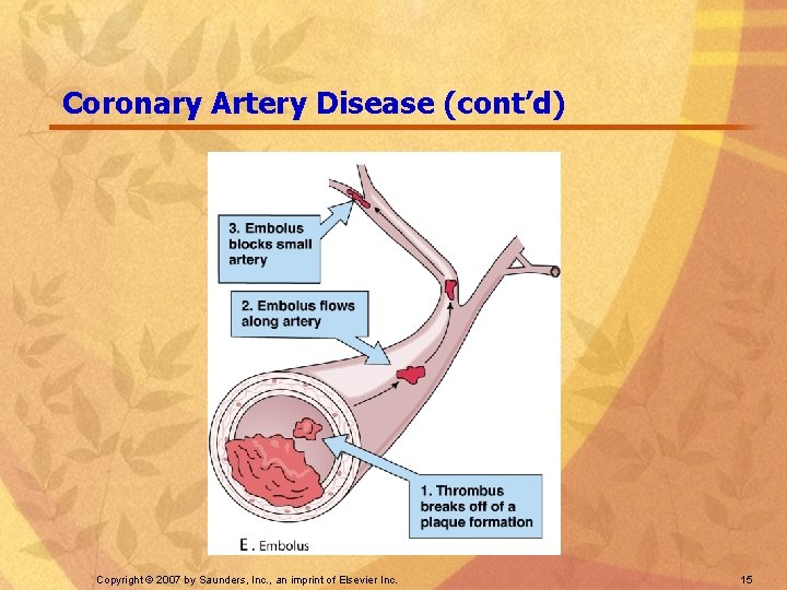 Coronary Artery Disease (cont’d) Copyright © 2007 by Saunders, Inc. , an imprint of