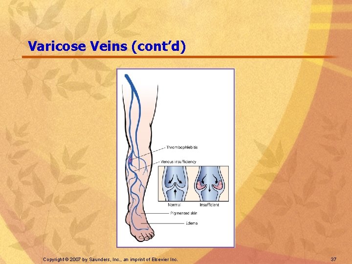 Varicose Veins (cont’d) Copyright © 2007 by Saunders, Inc. , an imprint of Elsevier