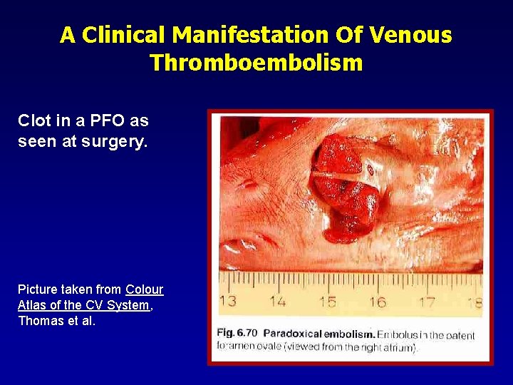A Clinical Manifestation Of Venous Thromboembolism Clot in a PFO as seen at surgery.