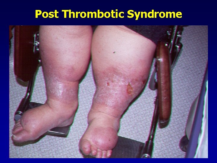 Post Thrombotic Syndrome 