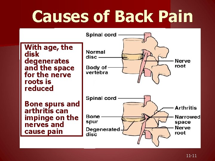 Causes of Back Pain With age, the disk degenerates and the space for the