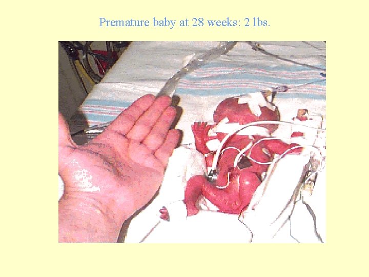 Premature baby at 28 weeks: 2 lbs. 