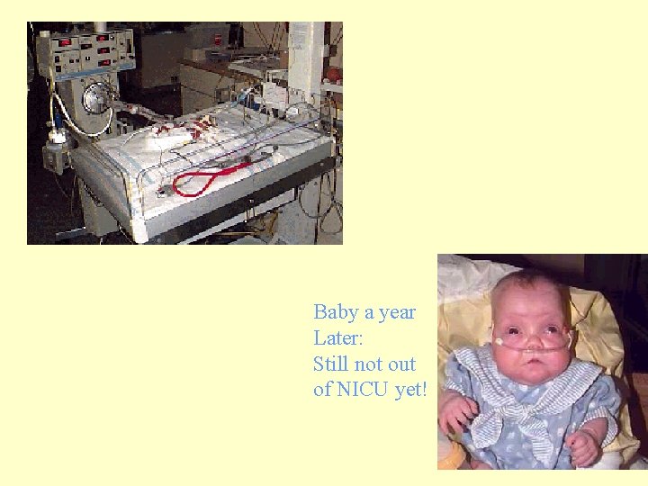 Baby a year Later: Still not out of NICU yet! 