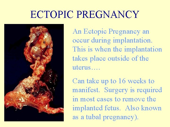 ECTOPIC PREGNANCY An Ectopic Pregnancy an occur during implantation. This is when the implantation