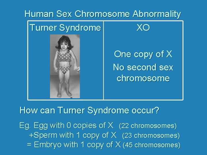 Human Sex Chromosome Abnormality Turner Syndrome XO One copy of X No second sex