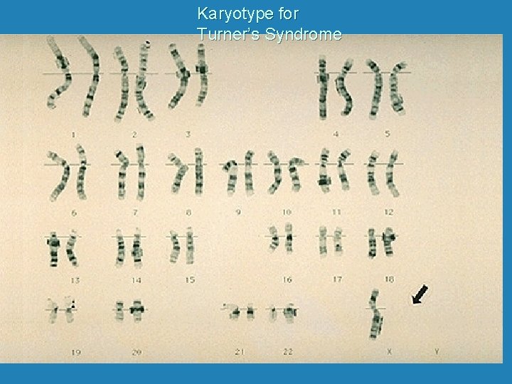 Karyotype for Turner’s Syndrome 
