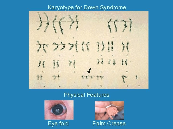 Karyotype for Down Syndrome Physical Features Eye fold Palm Crease 