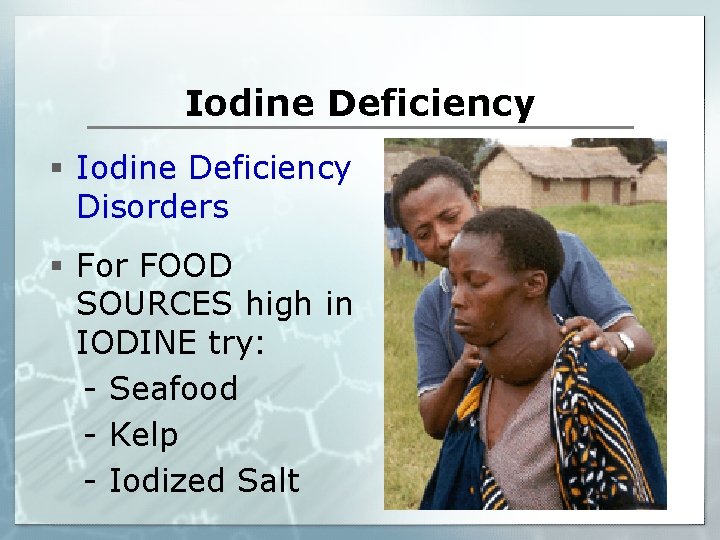 Iodine Deficiency § Iodine Deficiency Disorders § For FOOD SOURCES high in IODINE try: