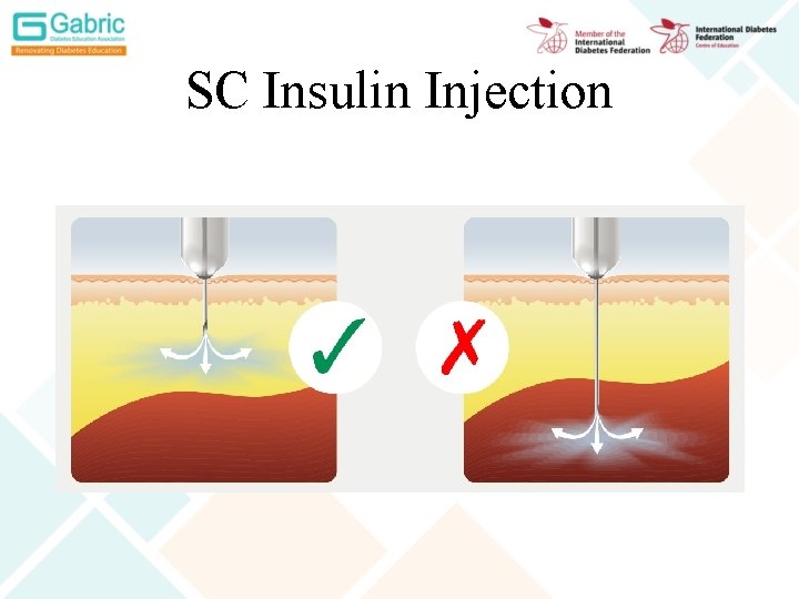 SC Insulin Injection 