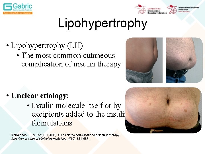 Lipohypertrophy • Lipohypertrophy (LH) • The most common cutaneous complication of insulin therapy •