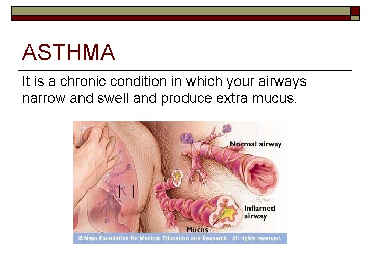 ASTHMA It is a chronic condition in which your airways narrow and swell and