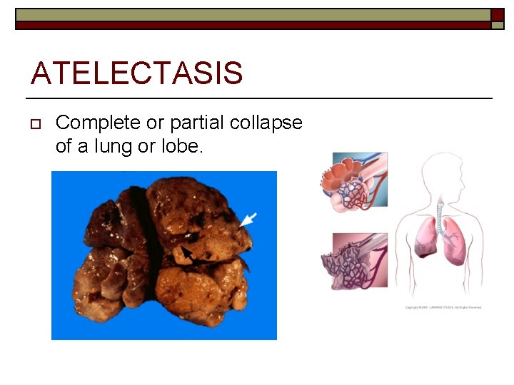 ATELECTASIS o Complete or partial collapse of a lung or lobe. 