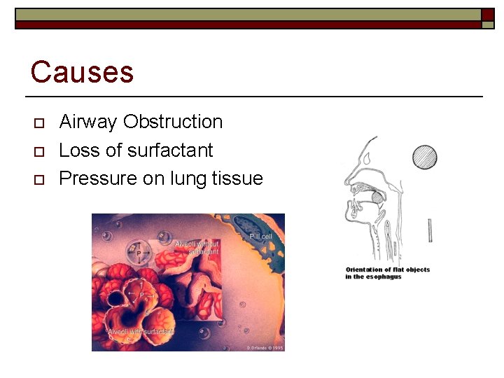 Causes o o o Airway Obstruction Loss of surfactant Pressure on lung tissue 