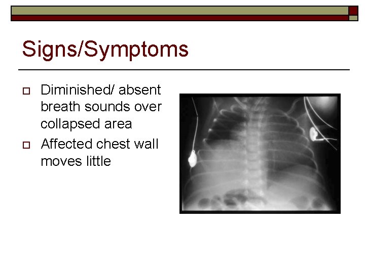 Signs/Symptoms o o Diminished/ absent breath sounds over collapsed area Affected chest wall moves