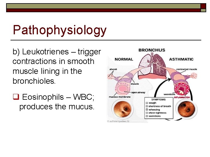 Pathophysiology b) Leukotrienes – trigger contractions in smooth muscle lining in the bronchioles. q