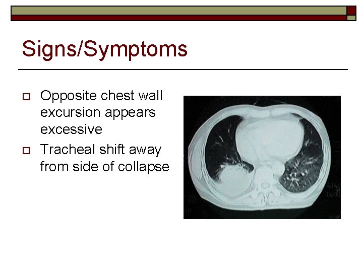 Signs/Symptoms o o Opposite chest wall excursion appears excessive Tracheal shift away from side