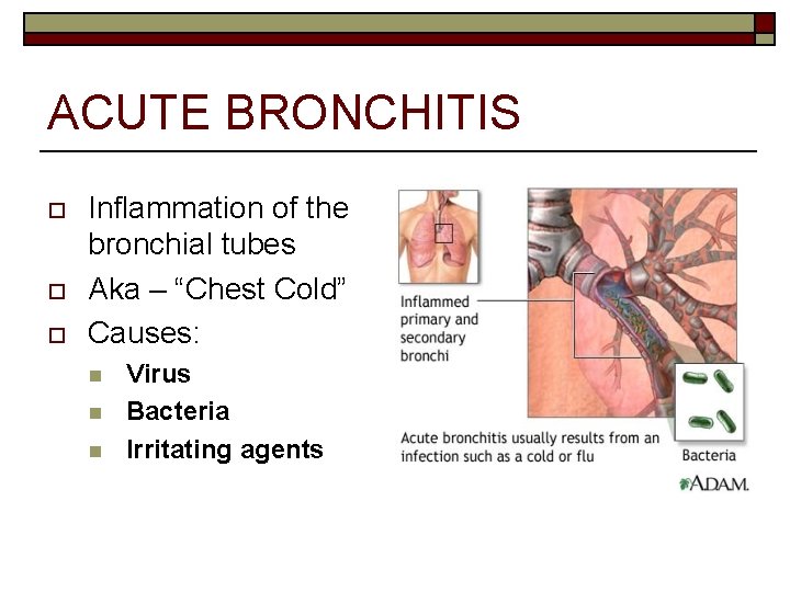 ACUTE BRONCHITIS o o o Inflammation of the bronchial tubes Aka – “Chest Cold”