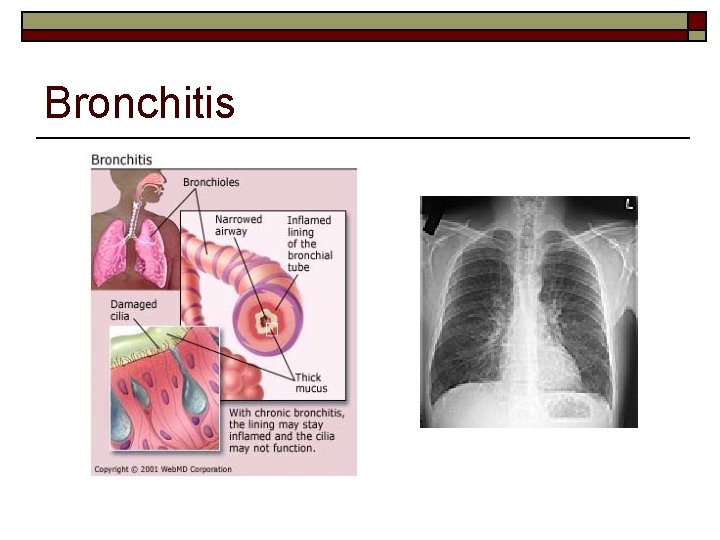 Bronchitis 
