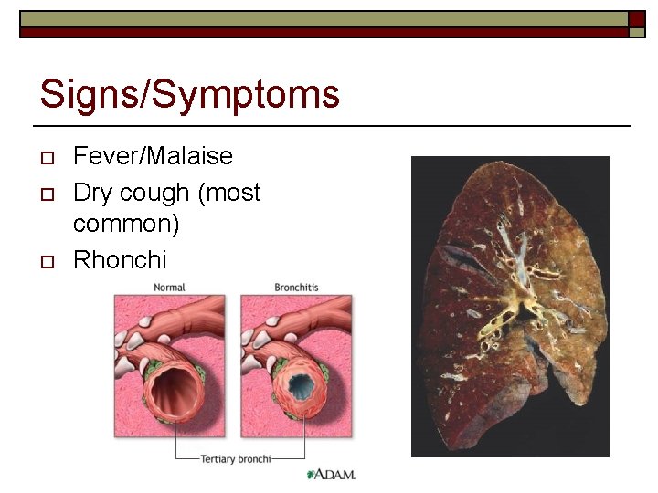 Signs/Symptoms o o o Fever/Malaise Dry cough (most common) Rhonchi 