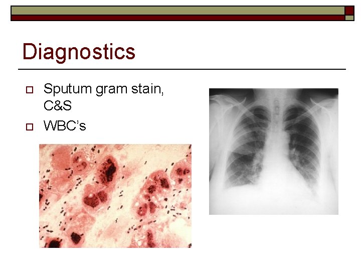 Diagnostics o o Sputum gram stain, C&S WBC’s 