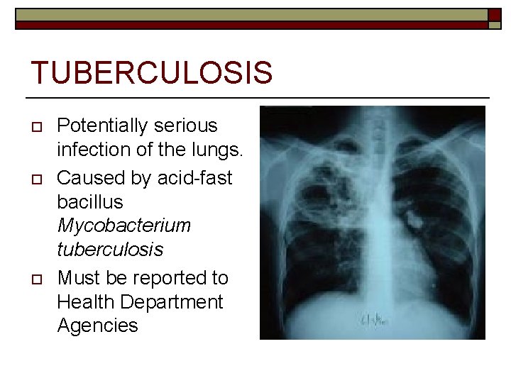 TUBERCULOSIS o o o Potentially serious infection of the lungs. Caused by acid-fast bacillus