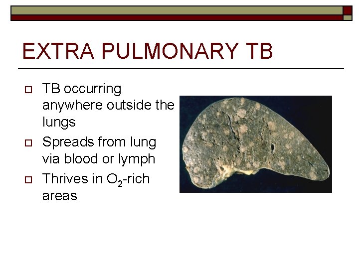 EXTRA PULMONARY TB o o o TB occurring anywhere outside the lungs Spreads from