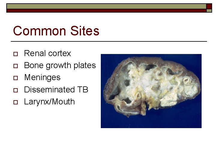 Common Sites o o o Renal cortex Bone growth plates Meninges Disseminated TB Larynx/Mouth